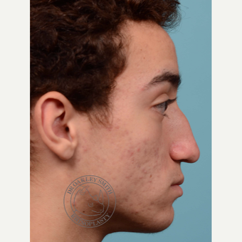 17 or under year old man treated with Septoplasty/open rhinoplasty before 3108917