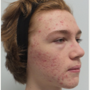 17 or under year old man treated with Infini RF, and Spectra Gold toning for Acne/Acne Scars before 2765694