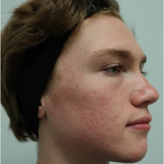 17 or under year old man treated with Infini RF, and Spectra Gold toning for Acne/Acne Scars after 2765694