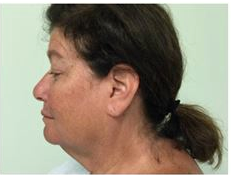 55-64 year old woman treated with Facelift before 3500712