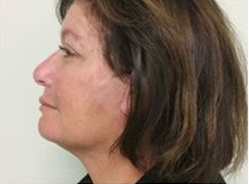 55-64 year old woman treated with Facelift after 3500712