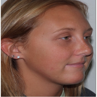 Rhinoplasty after 3324384