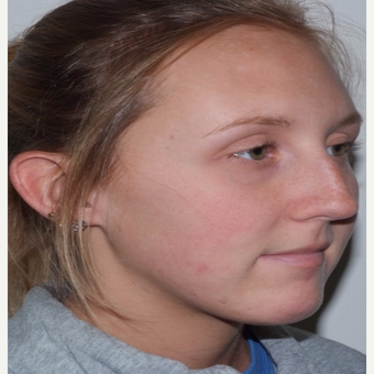 Rhinoplasty before 3324384