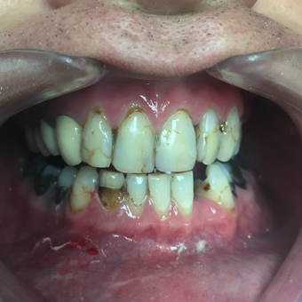 25-34 year old man treated with Dental Crown before 3273229
