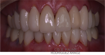 25-34 year old man treated with Dental Crown after 3273229