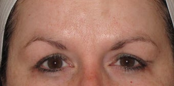 44 year old female for frown lines after 1389585