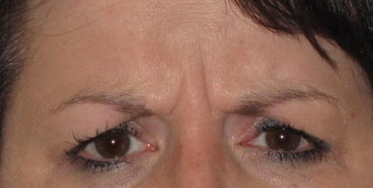 44 year old female for frown lines before 1389585