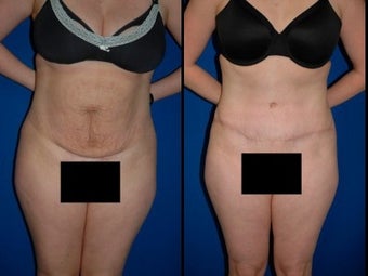 Tummy Tuck before 3054063