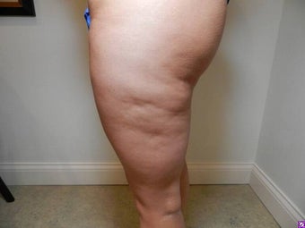 Cellulaze 1089009
