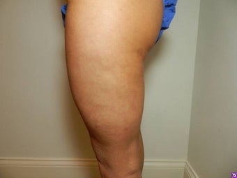 Cellulaze 1089009