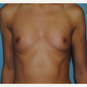 Breast augmentaiton with 300 cc silicone moderate profile plus before 3163520