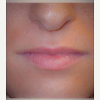 25-34 year old woman treated with Juvederm before 3186185
