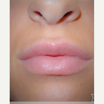 25-34 year old woman treated with Juvederm after 3186185