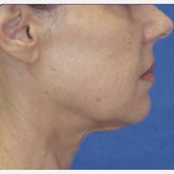 55-64 year old woman treated with skin tightening and wrinkle reduction Treatment after 2108902