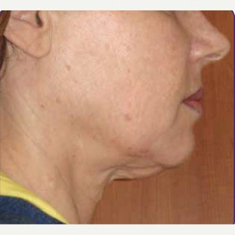 55-64 year old woman treated with skin tightening and wrinkle reduction Treatment before 2108902