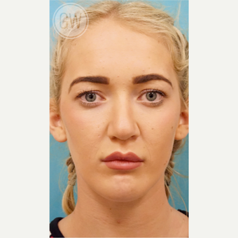 18-24 year old woman treated with Nose Surgery after 3473425