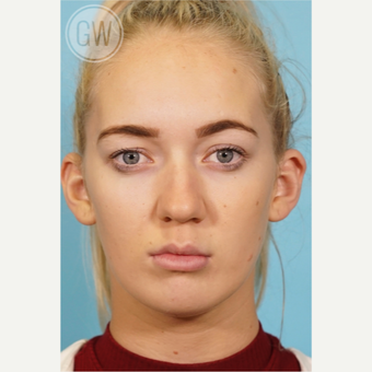 18-24 year old woman treated with Nose Surgery before 3473425