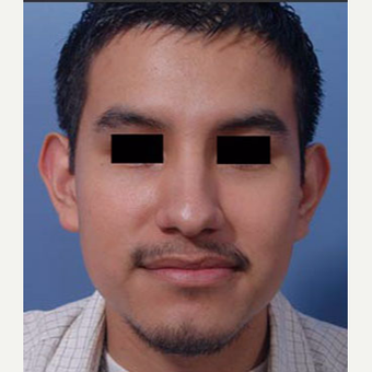18-24 year old man treated with Ear Surgery before 3725135