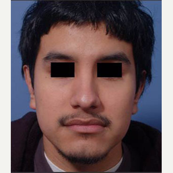 18-24 year old man treated with Ear Surgery after 3725135