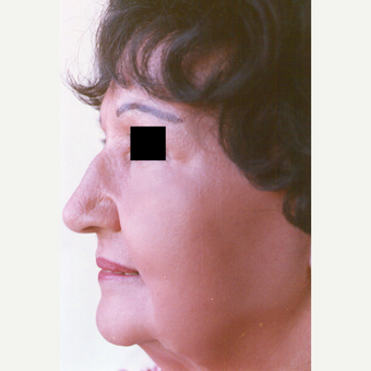 75 and up year old woman treated with Chemical Peel after 3543878