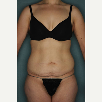 18-24 year old woman treated with Tummy Tuck before 3436180