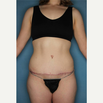 18-24 year old woman treated with Tummy Tuck after 3436180