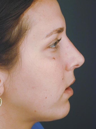 Female Chin Implant after 831449