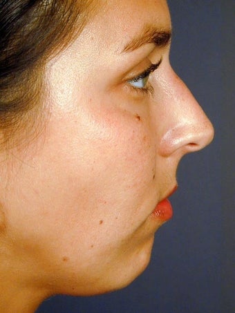 Female Chin Implant before 831449