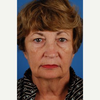 66 year old woman treated with Upper and Lower Eyelid Surgery before 3659132