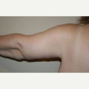 65-74 year old woman treated with Arm Lift after 1809404