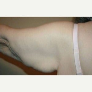 65-74 year old woman treated with Arm Lift before 1809404