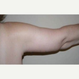65-74 year old woman treated with Arm Lift 1809404