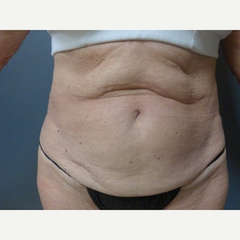 65-74 year old woman treated with Tummy Tuck before 1819218
