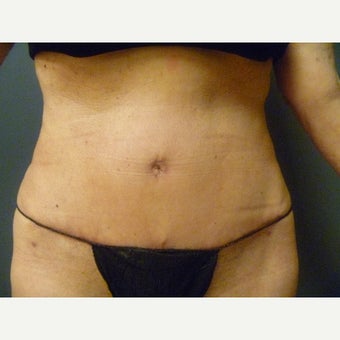 65-74 year old woman treated with Tummy Tuck after 1819218