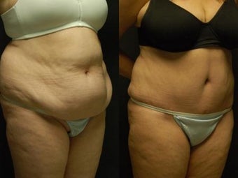 50 y/o Female, 5'7", 170 lbs 10 weeks after staged back and flank liposuction then abdominoplasty after 1460618