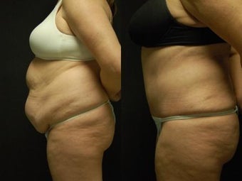 50 y/o Female, 5'7", 170 lbs 10 weeks after staged back and flank liposuction then abdominoplasty 1460618