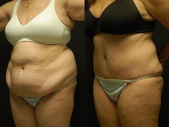 50 y/o Female, 5'7", 170 lbs 10 weeks after staged back and flank liposuction then abdominoplasty before 1460618