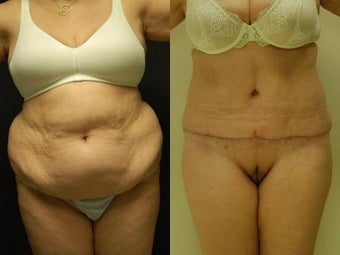 50 y/o Female, 5'7", 170 lbs 10 weeks after staged back and flank liposuction then abdominoplasty 1460618