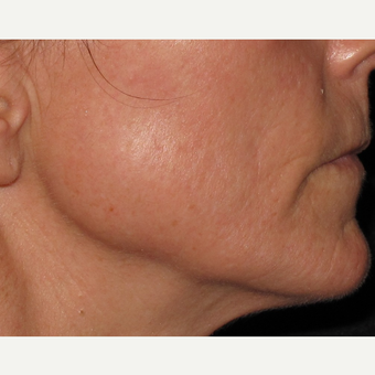 45-54 year old woman treated with Microneedling after 2713758