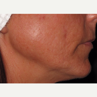 45-54 year old woman treated with Microneedling before 2713758