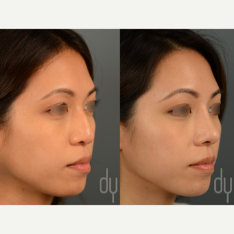 Asian Rhinoplasty with DCF before 3129945