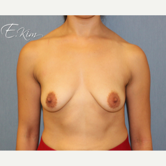25-34 year old woman treated with Breast Lift with Implants before 3663374