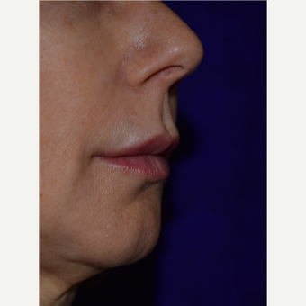 50 year old woman treated with Juvederm VOLBELLA after 3744403