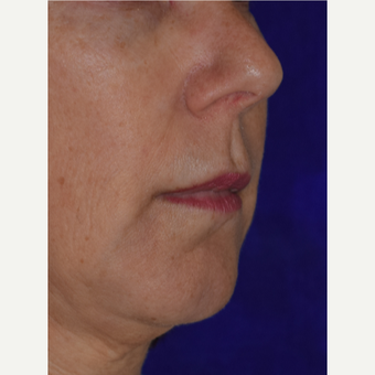 50 year old woman treated with Juvederm VOLBELLA before 3744403
