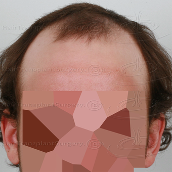 Dr Devroye - HTS Clinic - 2 FUT: 6103 grafts 13015 hairs - Result after 1 year post-op before 3162304
