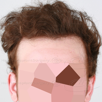 Dr Devroye - HTS Clinic - 2 FUT: 6103 grafts 13015 hairs - Result after 1 year post-op after 3162304