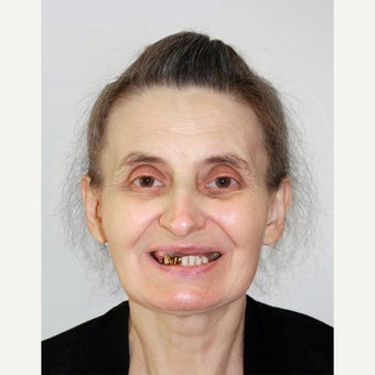 55-64 year old woman treated with All-on-4 Dental Implants before 1667462