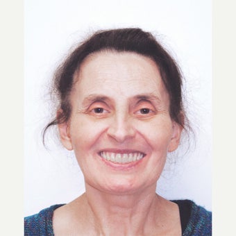 55-64 year old woman treated with All-on-4 Dental Implants after 1667462