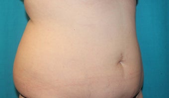 45-54 year old woman treated with CoolSculpting 3027679