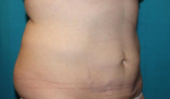 45-54 year old woman treated with CoolSculpting 3027679